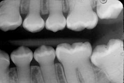 <p>-calcified pulp chambers; bell shaped teeth; this is a hereditary disorder. </p><p>-This condition is sometimes correlated with osteogenesis imperfecta </p>
