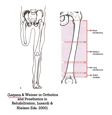 <p>transfemoral amputation </p>