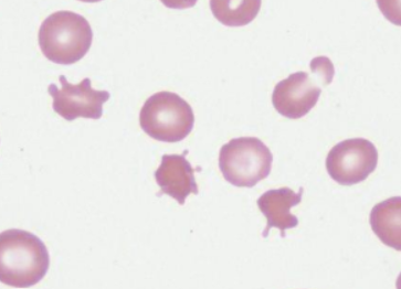 <p>Identify the RBC morphology </p>