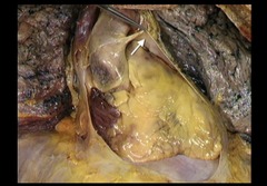 <p>In this anterior view of the heart in situ, identify the structure indicated by the arrow.</p><p>Epicardium</p><p>Parietal pleura</p><p>Parietal pericardium</p><p>Visceral pleura</p>