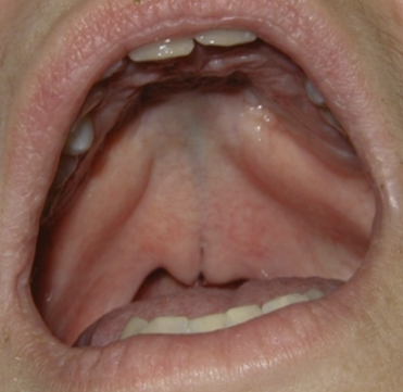 <p>surface is intact but defect exists in the underlying musculature of the soft palate </p>