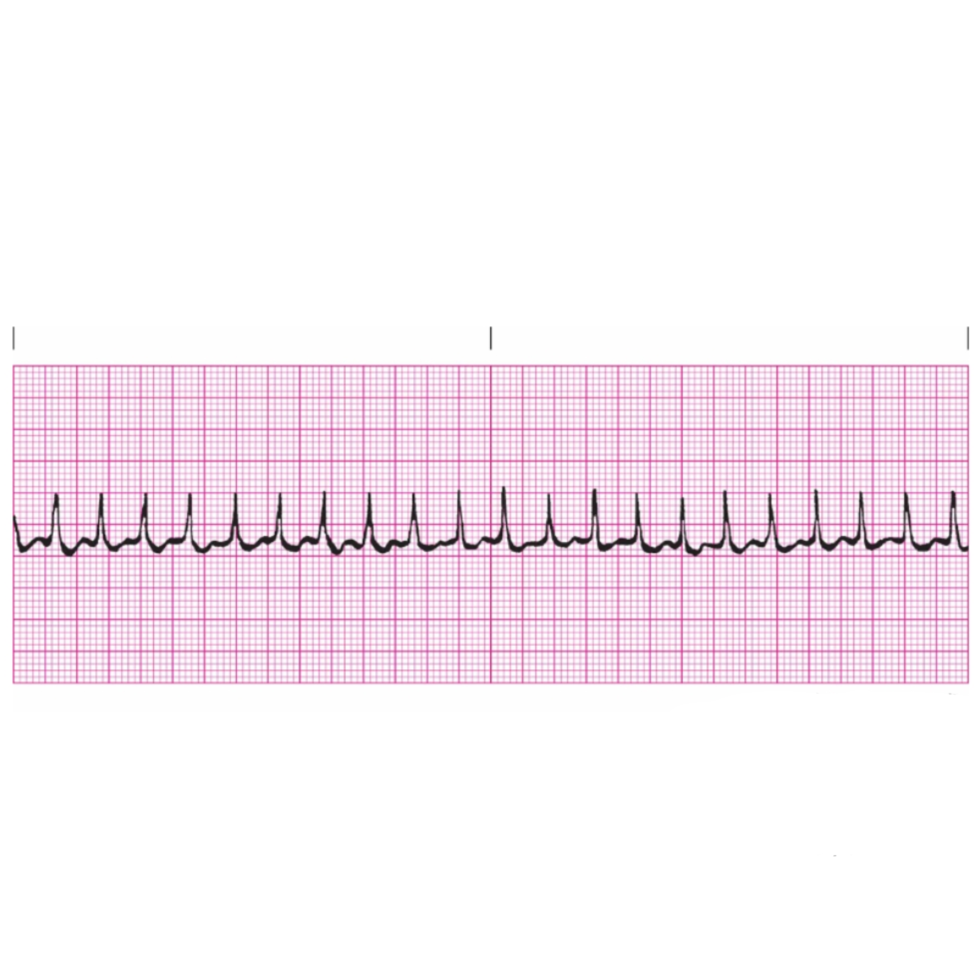 <p>Rules for Atrial Tachycardia includes</p>
