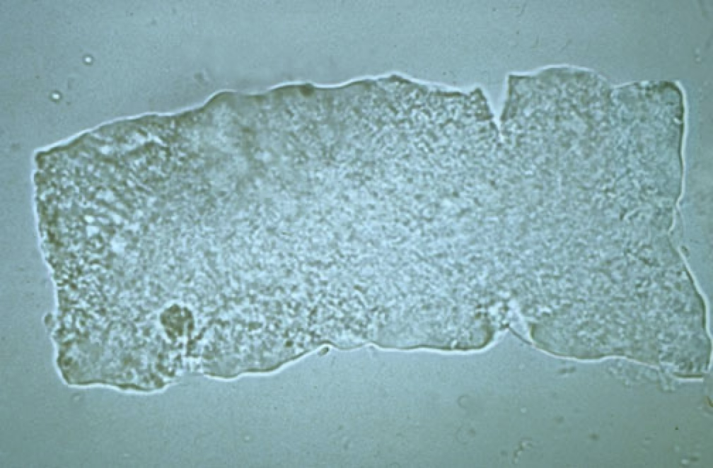 <ul><li><p>Resemble hyaline casts, but typically wider with square ends.</p></li><li><p>Their presence indicates chronic, severe degeneration of the renal tubules.</p></li></ul><p></p>