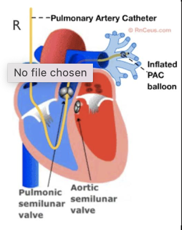 <p>Swan-Ganz (Pulmonary Artery Catheter)</p>
