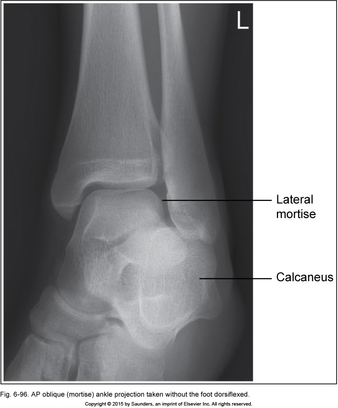 <p>AP oblique ankle (mortise)</p>