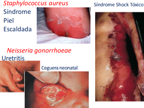 <ul><li><p>Staphylococcus aureus: Sindrome de piel escamada y sindrome de shock tóxico</p></li><li><p>Neisseria gonorrhoeae: Uretritis y ceguera neonatal</p></li></ul><p></p>