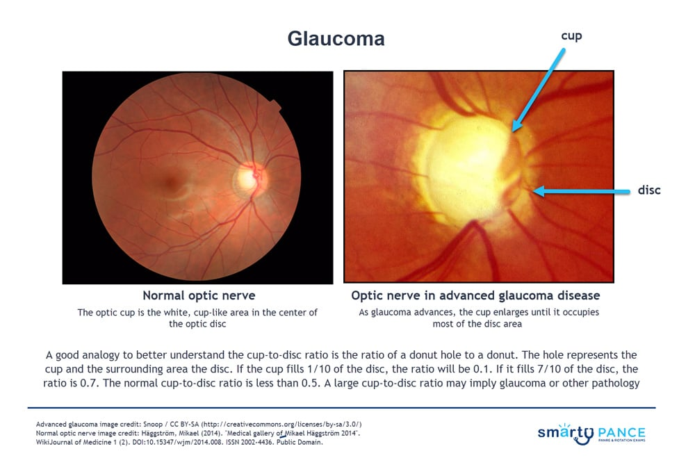 <p>Most common type of glaucoma that affects the outflow of aqueous humor </p><p>-Presentation: peripheral to central gradual visual loss in an older African American individual </p><p>-Dx: tonometry shows increased IOP, peripheral field testing, optic disc monitoring </p><p>-Tx: prostaglandin analog drops (latanoprost), topical timolol, trabeculoplasty to open meshwork </p>