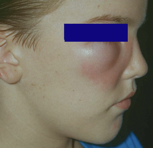 <p>The classic history for a patient with a __________ infection is someone from Central/West Africa with <strong>Calabar Swellings </strong>wherever the worm migrates. You may also be able to see the worm moving across the eye.</p>