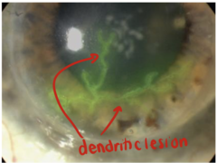 <p>fluorescein exam shows corneal ulcer (branching), dendritic lesion in HSV keratitis</p>