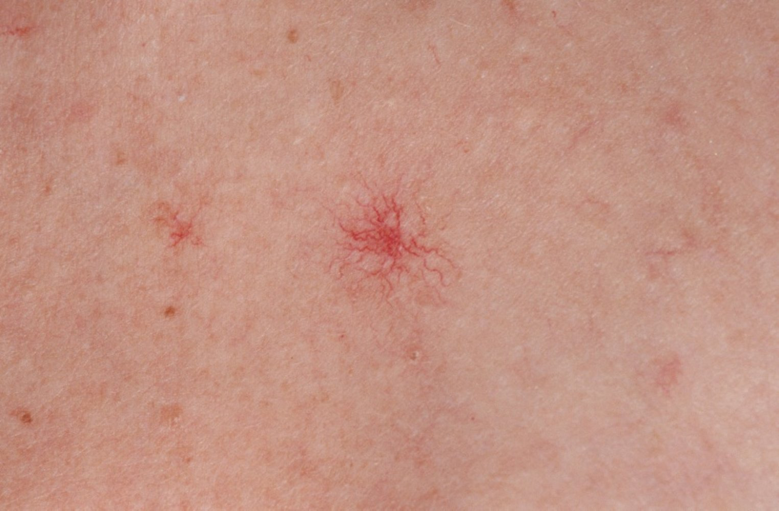 <p><span>benign, vascular lesions, they more characteristically manifest on the trunk as a central red </span>arteriole<span> with numerous, thin, arterial extensions (resembling a spider's body). Also typically occur in patients with excess </span>estrogen<span> exposure (e.g., patients with </span>cirrhosis<span>).</span></p>