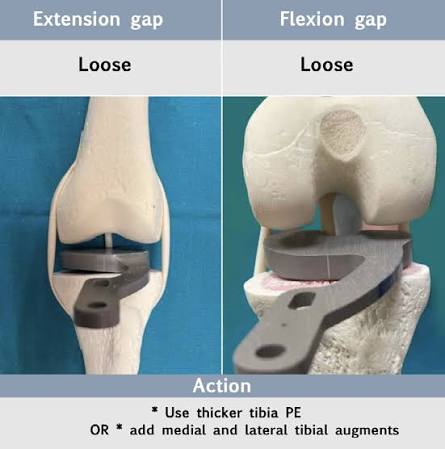 <p>Checks the flexion/extension gap after the cuts.</p>