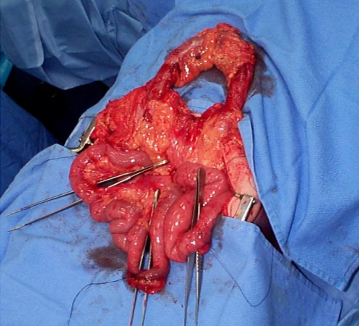 <p>Bucket Handle Injury</p>