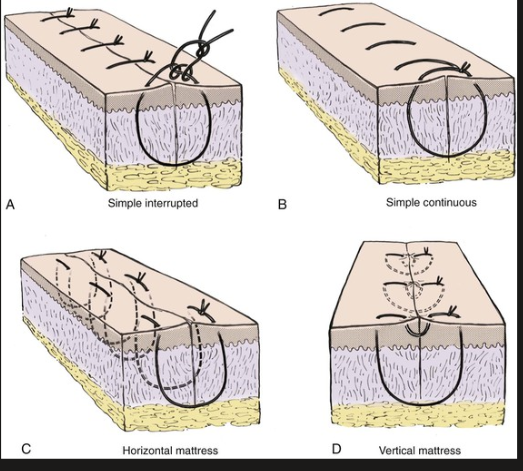 <ol><li><p>how to do it:</p></li></ol><ul><li><p>First bite = far from wound edge on one side → exit far on opposite side</p></li><li><p>second bite = return near the wound edge → Exit Near on opposite side</p></li><li><p>tie </p></li></ul><ol start="2"><li><p>Entry/ exit</p></li></ol><ul><li><p>far-far than Near-near (vertical plane)</p></li></ul><ol start="3"><li><p>important</p></li></ol><ul><li><p>create U shape</p></li><li><p>gives excellent eversion and strong tension control</p></li></ul><p></p>
