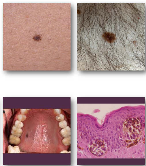 <ul><li><p>usually flat</p></li><li><p>singular</p></li><li><p>all melanocytes at junction of epithelium and connective tissue</p></li></ul><p></p>