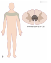 <p><span style="background-color: transparent;"><span>-Hyperextension injuries in the </span><u><span>cervical region</span></u></span></p><p><span style="background-color: transparent;"><strong><span>-UE>LE involvement</span></strong></span></p><p><span style="background-color: transparent;"><span>-Bilateral loss of pain &amp; temp</span></span></p><p><span style="background-color: transparent;"><span>-Proprio &amp; discriminatory sensation are preserved</span></span></p><p><span style="background-color: transparent;"><span>-Function retained in all other spinal regions</span></span></p><p><span style="background-color: transparent;"><span>-Sacral sparing (usually retains bowel/bladder/sexual function)</span></span></p><p><br></p>