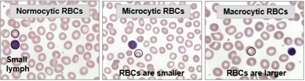 <p>MCV: RBC Size</p><ul><li><p><span style="background-color: transparent;">Normal MCV (82.0-98.0 fL): normocytic red cells, about the size as the nucleus of a small lymph</span></p></li></ul><ul><li><p><span style="background-color: transparent;">Small MCV (<82.0 fL): microcytic red cells</span></p></li><li><p><span style="background-color: transparent;">Large MCV (98.0 fL): macrocytic red cells</span></p></li></ul><p></p>