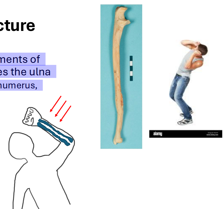 <p>Special: Parry Fracture</p>