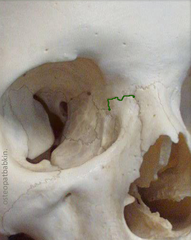 <p>What type of suture is shown?</p>