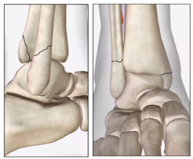 <p>What fracture is this?</p>