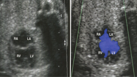 <ul><li><p>previously referred to as <span style="color: red;"><em>endocardial cushion defects</em></span> of A-V canal defect</p></li><li><p>defect in the <span style="color: red;">central part of the heart</span></p><ul><li><p>defect includes: interatrial septum; interventricular septum; mitral valves; tricuspid valves</p></li></ul></li><li><p>results from malformation in the development of endocardial cushion</p></li><li><p>good prognosis with surgery worse when associated abnormalities are present</p></li><li><p>defect is <span style="color: red;">visualized best in 4CH</span></p></li><li><p>color and spectral Doppler are useful in demonstrating flow directions and degree of regurgitation</p></li></ul><p></p>