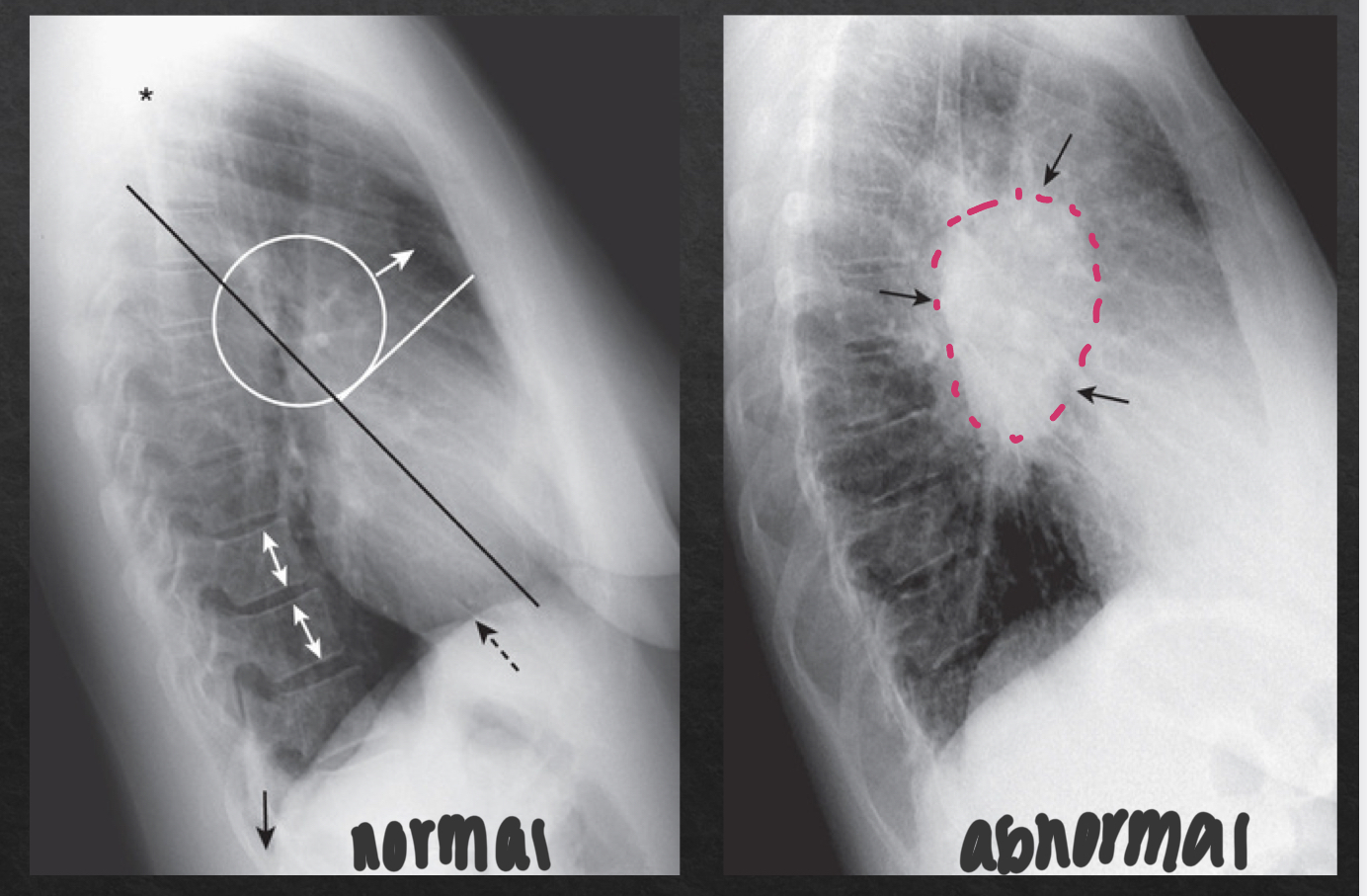<ul><li><p>consists of pulmonary vasculature, pymph nodes, aft, and major bronchi</p></li><li><p>NORMAL</p><ul><li><p>no discrete mass present</p></li></ul></li><li><p>ABNORMAL</p><ul><li><p>distinct, opaque hilar mass</p></li></ul></li></ul><p></p>