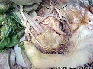 <p>what artery is being indicated to in the image? context: left lobe of liver has been removed</p>