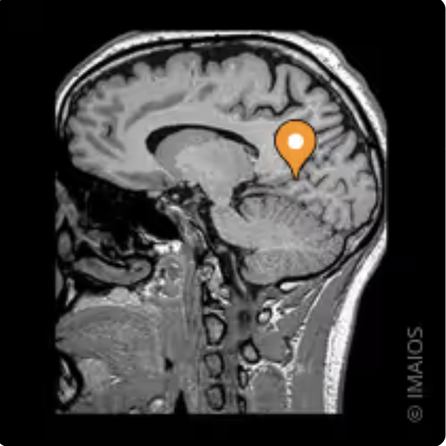 <p>Name the sulcus, modality, and plane</p>