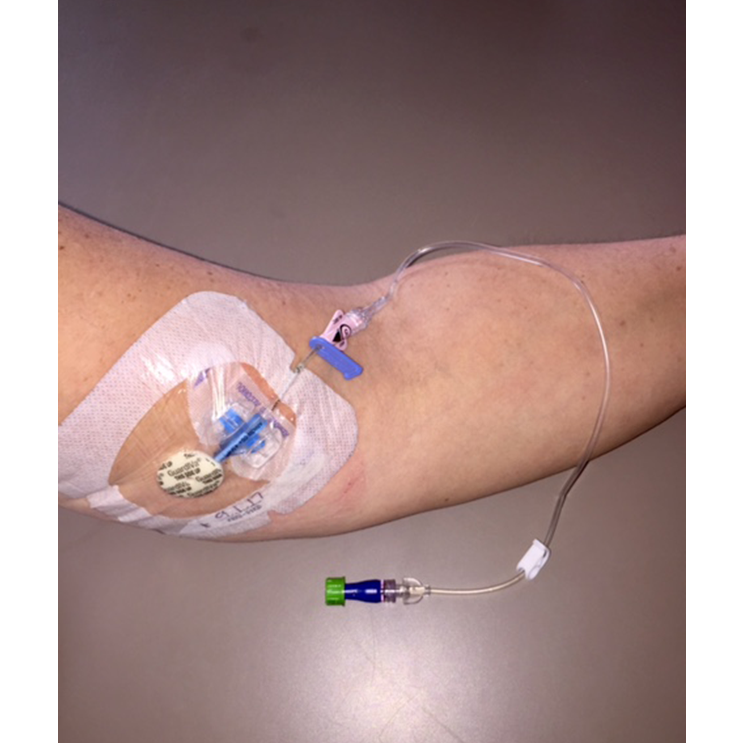 <p>A physical therapist treats a patient four weeks following a laminotomy due to impingement on a spinal nerve root. The therapist notices that that the patient’s arm houses a medical device as shown in the image. The medical record indicates that the patient is currently taking vancomycin. What is the <strong>MOST</strong> likely purpose of the medical device?</p><p> <strong>1. </strong>Administer pain medication to control pain</p><p><strong> 2. </strong>Deliver an antibiotic to combat infection</p><p><strong> 3. </strong>Administer electrical current to promote bone stimulation</p><p><strong> 4. </strong>Administer fluids to prevent dehydration</p><p></p>
