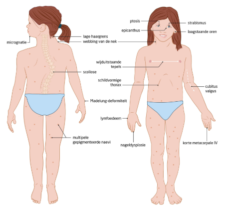 <p>Een primaire groeistoornis die enkel bij meisjes voorkomt en waarbij één van de twee X-chromosomen volledig of gedeeltelijk ontbreekt.</p><p>Kenmerken:</p><p>-Kleine lengte.</p><p>-Brede kort nek met opgezette handen en voeten.</p><p>-Hartafwijkingen (vooral coarctatio aortae) en nierafwijkingen.</p><p>-Onvoldoende ontwikkelde eierstokken waardoor weinig oestrogeen aangemaakt wordt → geen menstruatie en geen borsten.</p><p>-Onvruchtbaar</p><p>-Leerstoornissen</p><p>-Scoliose, otitis media, gehoorverlies, coeliakie, oogproblemen.</p><p>=> De diagnose wordt gesteld via genetisch onderzoek. Ongeneeselijk maar een behandeling met groeihormoon en oestrogeentherapie is mogelijk, andere behandelingen hangen af van de symptomen.</p>