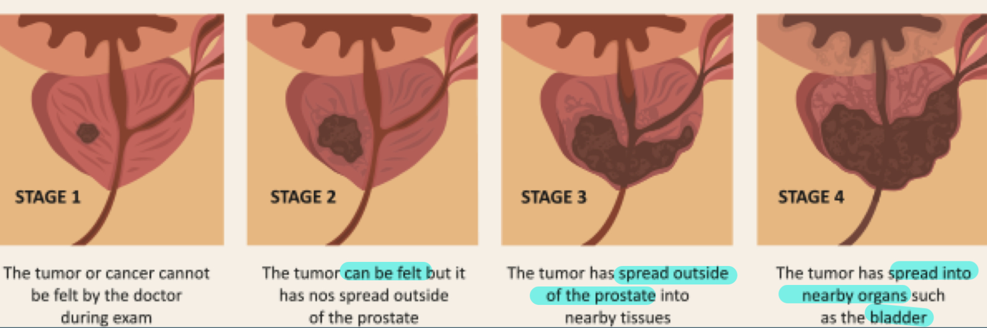 <p>(prostate lies directly anterior to rectum)</p><ul><li><p>stage 1: tumor/cancer cannot be felt by doctor during exam</p></li><li><p>stage 2: tumor can be felt but it has not spread outside of prostate</p></li><li><p>stage 3: tumor has spread outside of prostate into nearby tissues</p></li><li><p>stage 4: tumor has spread into nearby organs such as bladder</p></li></ul><p></p>