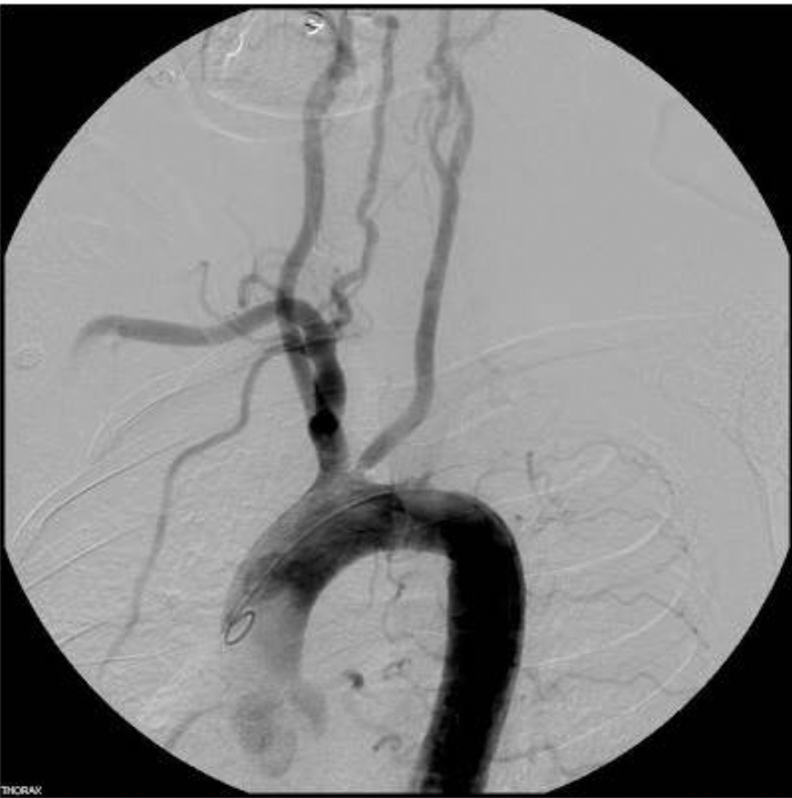 <p>According to the findings on this arteriogram, which of the following symptoms would be explained by the findings?</p><p>A. Left leg paresthesia</p><p class="p1">B. Right arm paralysis</p><p class="p1">C. Left arm paresthesia</p><p class="p1">D. Isolated visual disturbances in the left eye</p>