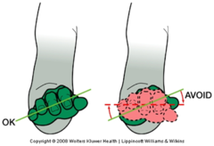 <p>- Little finger side of palm is slightly lower than thumb side of palm</p><p>- Wrist aligned with forearm</p>
