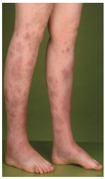 <p>Oorzaak van gastro-enteritis</p><ul><li><p>incubatietijd= 4-7 dagen</p></li><li><p>slepend verloop bij jonge kinderen (2-4 weken!)</p></li><li><p>abdominale pijn, kolieken, koorts en braken bij oudere kinderen en volwassenen (pseudo-appendiculair syndroom)</p></li><li><p>onze streken: vnl. serotype O:3, minder serotype O:9, zeldzaam andere serotypes</p></li><li><p>associatie met het eten van rauw varkensvlees (rauw gehakt, varkenstongen…)</p></li></ul><p>Zeldzaam sepsis</p><ul><li><p>belangrijke risicofactoren: hemochromatose, gedaalde afweer (oa. verminderde fagocytose), toegenomen virulentie van de bacterie</p></li><li><p>via bloedtransfusie door mogelijke groei van Y. enterocolitica bij koelkasttemperatuur en stimulatie van de groei door exogeen ijzer (bloedzakken)</p></li></ul><p>Post-infectieuze complicaties</p><ul><li><p>reactieve artritis tgv. neerslag Ag-AL complexen in de verschillende gewrichten: enkele dagen tot 1 maand na start van de diarree, bij 10-30% van de volwassenen, symptomen duren gemiddeld 1-4 maanden</p></li><li><p>erythema nodosum tgv. neerslag Ag-AL complexen in de oppervlakkige arteriolen</p></li></ul><p></p>