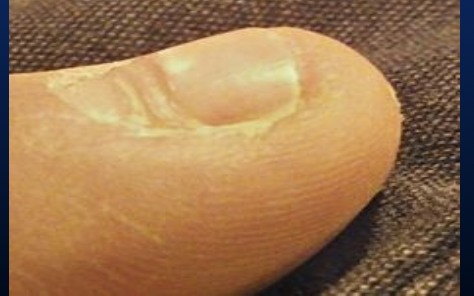 <p>Transverse depressions in the nail plate often caused by infection or decreased circulation.</p>