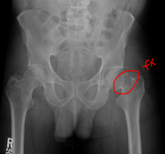 <p>- groin pain</p><p>- shortening and external rotation</p>