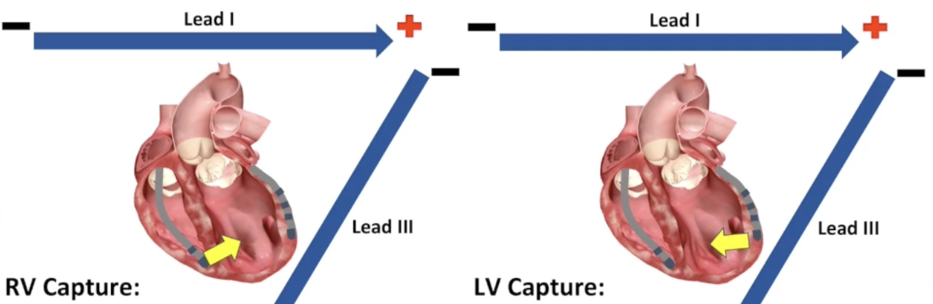 <p>RV Capture:</p><p>Lead I: more positive</p><p>Lead III: more negative</p><p>LV Capture:</p><p>Lead I: more negative</p><p>Lead III: more positive</p>