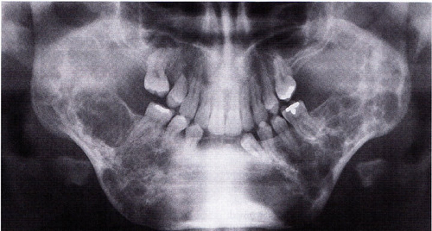 <p><br>-bilateral facial swelling that appears when the patient is between 1.5 and 4 years of age</p><p>-soap bubble appearance</p>