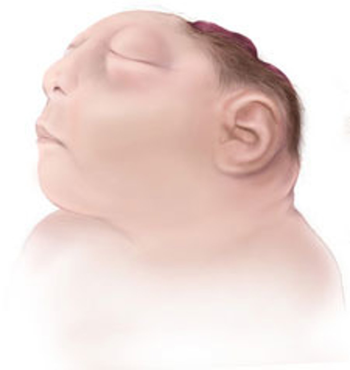 <p>- Absence of brain tissues; infants are stillborn or die soon after birth</p><p>- Those who are at risk are 1 in 1,000</p><p>- However, it cant be treated because there is no treatment.</p>