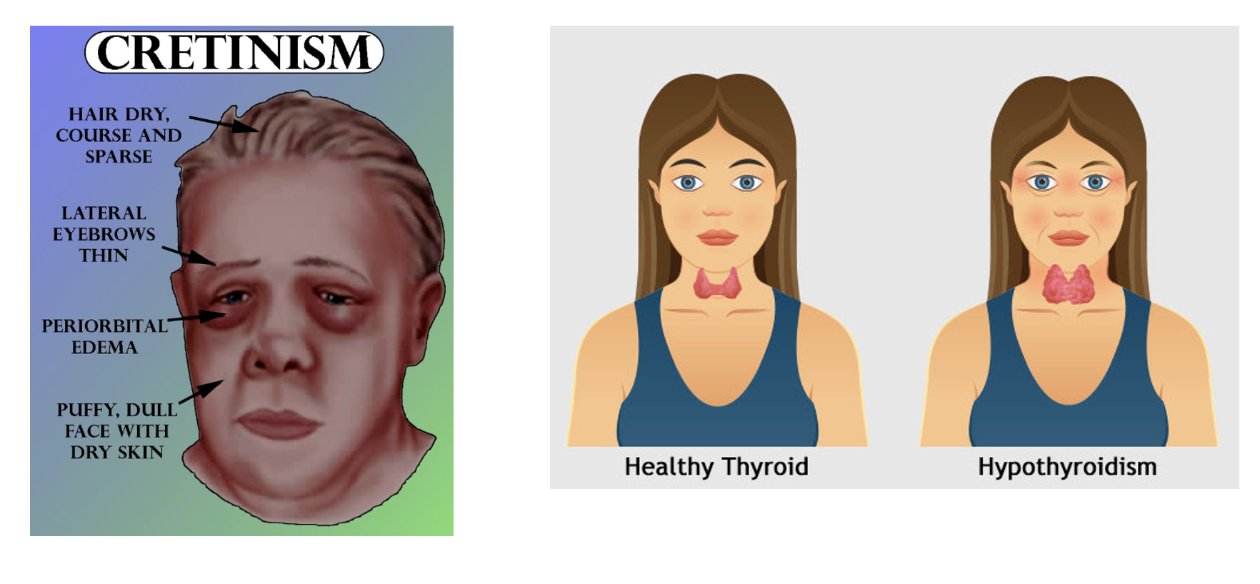 <p><span>•Found in some types of seafood and in plants that are grown in soil that naturally contains iodine</span></p><p><span>•Deficiency associated with a growth on the thyroid called a goiter and the failure to develop full intellectual potential</span></p><p><span>•Often occurs in people who live in mountainous regions where less seafood is consumed and the soil is deficient in iodine</span></p>
