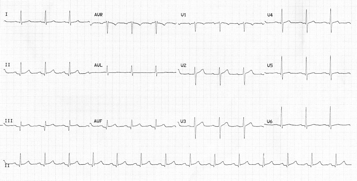 <p>Patient presents with the following ECG and a troponin value of 0.24 ng/ml. What is the diagnosis?</p>
