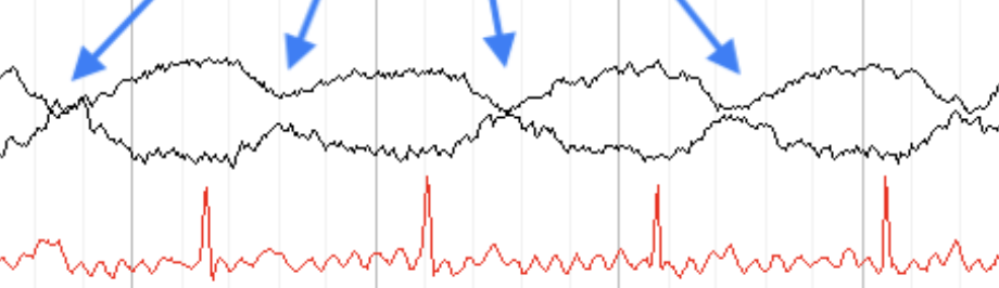 <p>electrode on artery <span data-name="skull" data-type="emoji">💀</span> </p>