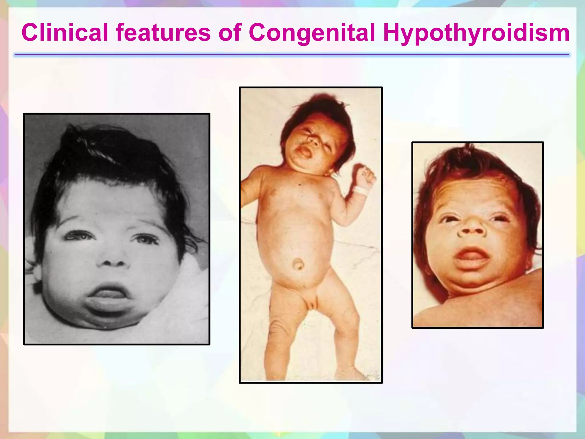 <ol><li><p><span style="color: rgb(240, 102, 102);"><strong>short, thick neck</strong></span></p></li><li><p><span style="color: rgb(124, 79, 219);"><strong>hypotonia </strong></span>w/ <span data-name="arrow_down" data-type="emoji">⬇</span>reflexes</p></li><li><p><span style="color: rgb(173, 186, 50);"><strong>jaundice</strong></span></p></li><li><p><span style="color: rgb(203, 31, 215);"><strong>enlarged tongue</strong></span> (macroglossia)</p></li><li><p><span style="color: rgb(28, 150, 129);"><strong>sleep alot</strong></span></p></li><li><p><span style="color: rgb(142, 123, 29);"><strong>poor sucking</strong></span></p></li><li><p><span style="color: rgb(22, 110, 197);"><strong>abd distention/constriction</strong></span></p></li></ol><p></p><ul><li><p>baby born w/ low TH levels</p></li></ul><p></p>
