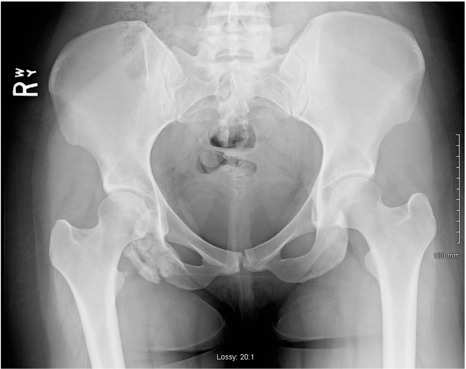 <p>Patient has low back pain, what is the diagnosis?</p>