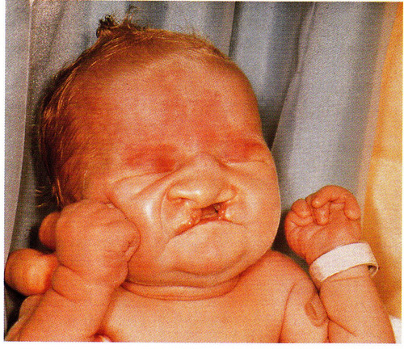 <p><br><span>-abnormalities in multiple organs</span></p>