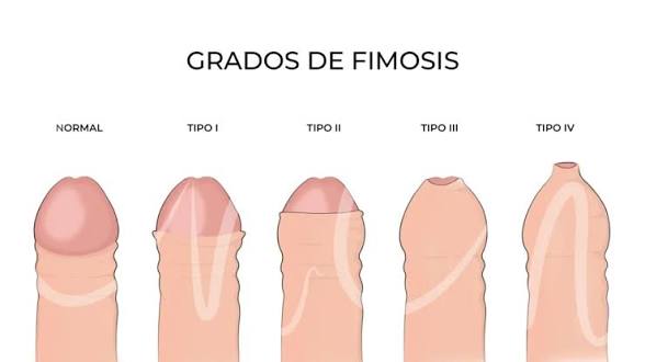 <p>Estrechamiento o la falta de elasticidad del prepucio. </p>