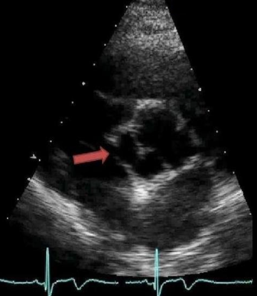 <p>this abnormality is associated with what clinically critical complication? </p>