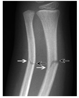<p>Cortex not fully broken; includes greenstick, torus, buckle.</p>