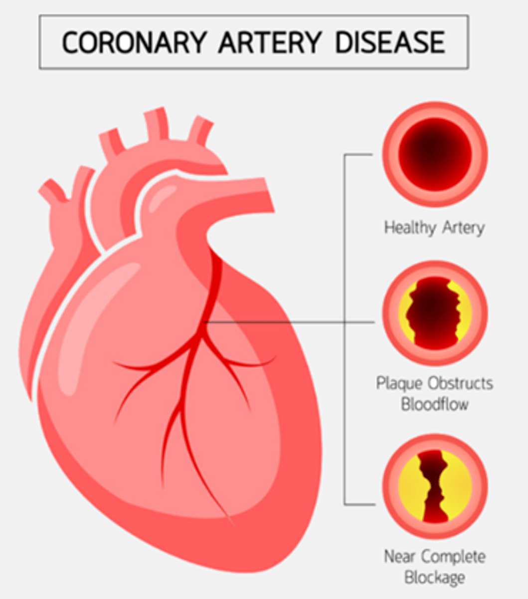 <p>B) Decreasing blood flow (and oxygen as a result) to the myocardial tissue due to atherosclerotic plaque deposits in the coronary artery</p>