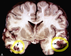 <p>What are gross features of an acute contusion?</p>