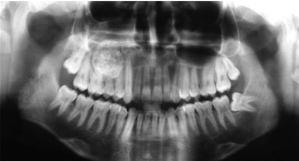 <p>osteoblastoma</p>